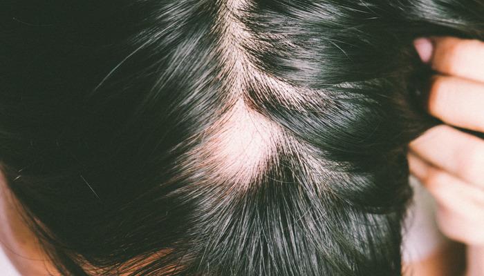 Saçkıran nedir ve buna ne sebep olur?  Saçkıran nasıl tedavi edilir?