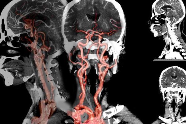 Dikkat! Mevsim geçişleri beyin kanaması riskini artırıyor… Açıklayan uzman, özellikle sonbahar ve ilkbahara dikkat çekti